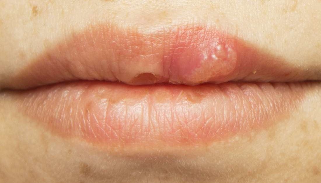 HIV mouth sores: Pictures, causes, treatment, and prevention