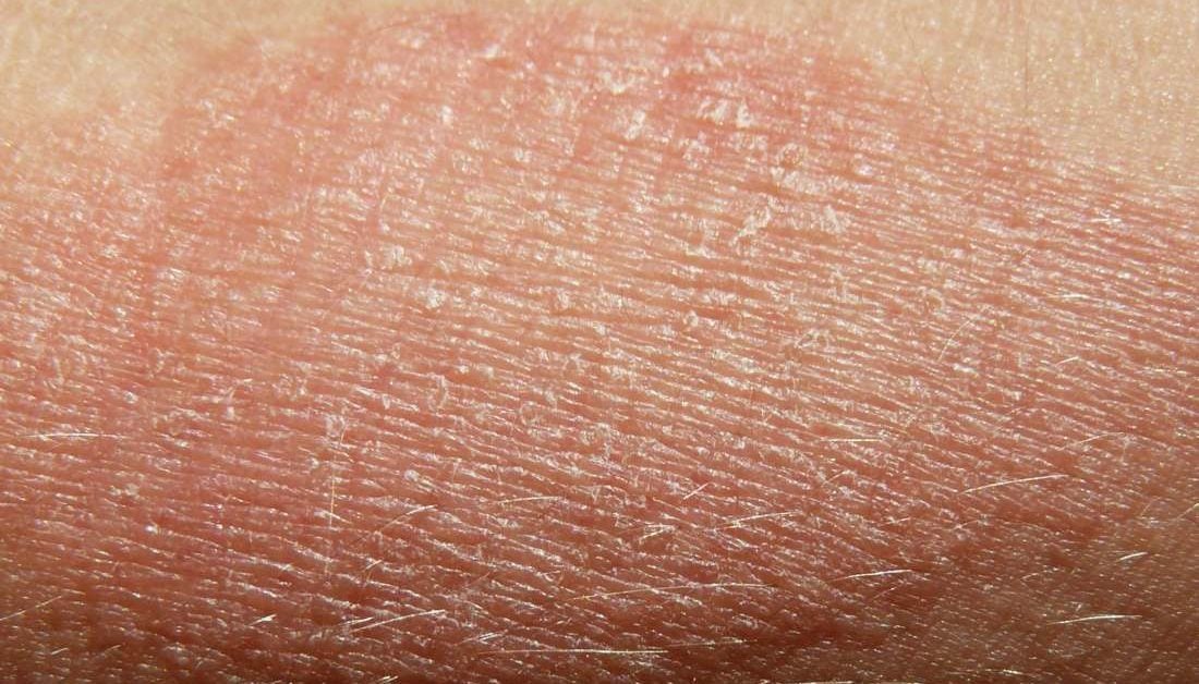 Dry skin patches: Causes, symptoms, diagnosis, and treatments