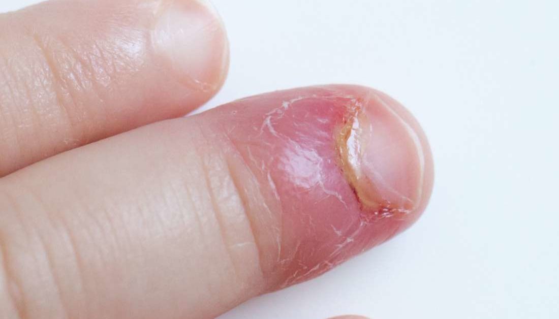 How To Treat An Infected Finger At Home