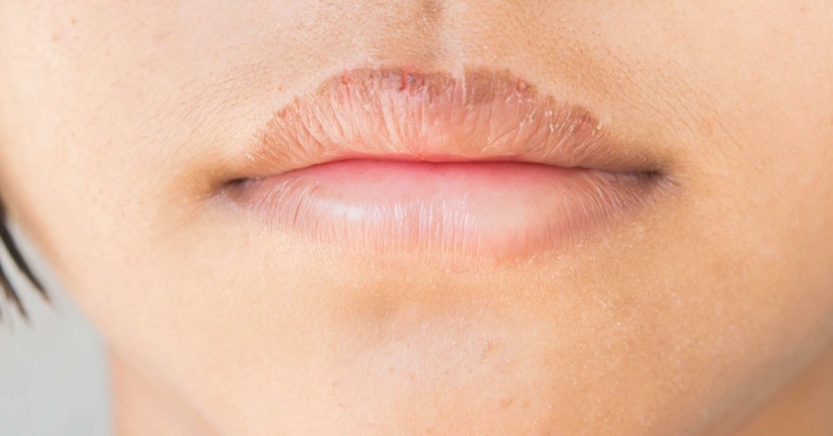 Can Dryness Cause Swollen Lips