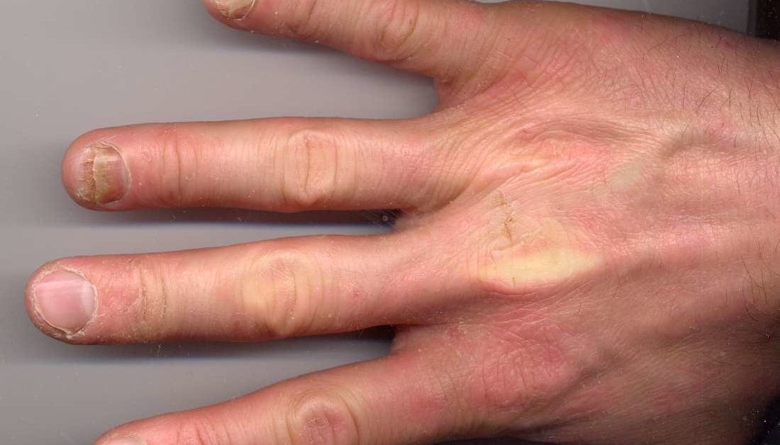 psoriatic-arthritis-and-nails-changes-pictures-and-treatment