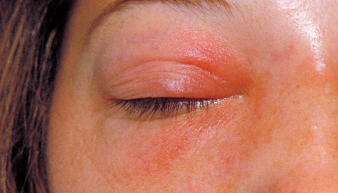 Orbital cellulitis Symptoms, causes, and treatment