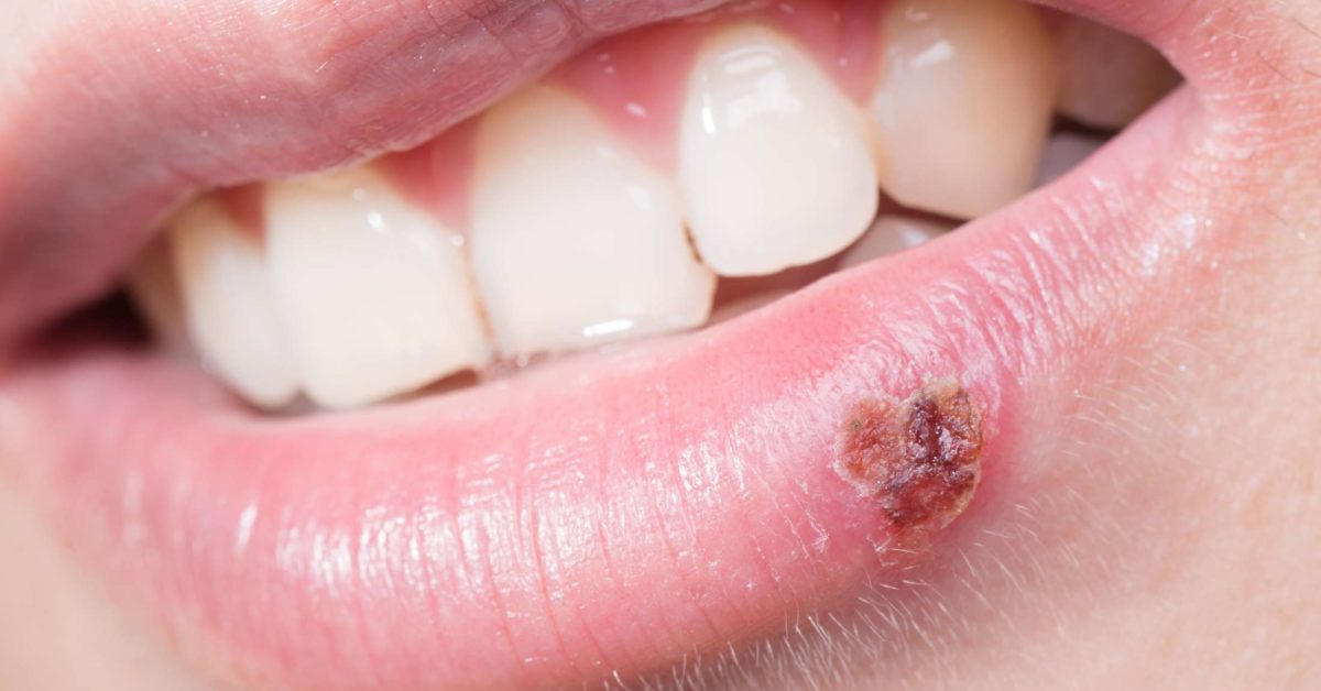 an-overview-of-a-cold-sore-outbreak-cold-sore-treatment-lips-cold