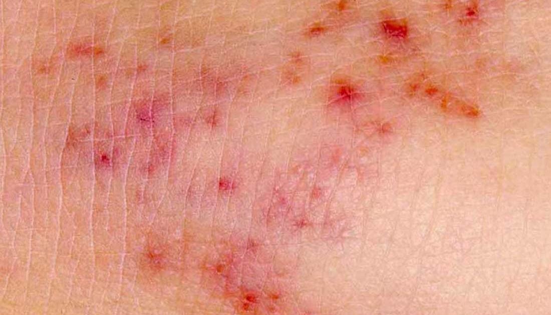 Meningitis Rash Pictures Symptoms And Similar Rashes 5841