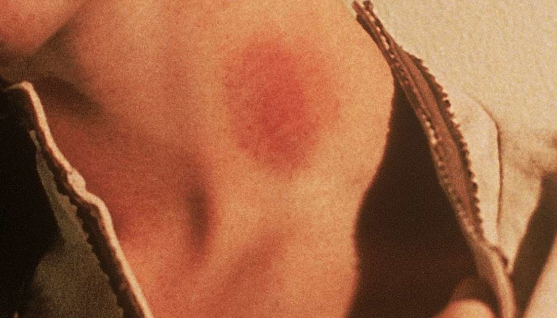 how-to-get-rid-or-hide-hickeys-howtormeov