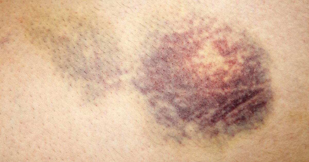 Hematoma: Overview, types, treatment, and pictures