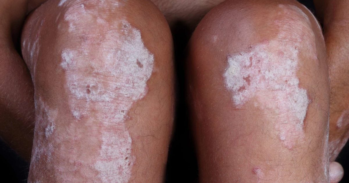 Psoriasis On Black Skin Pictures Symptoms And Treatment