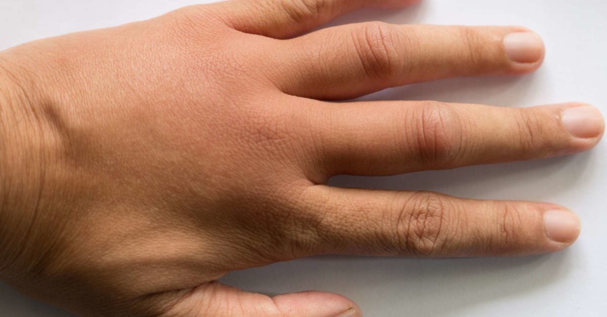 What are the causes of swollen hands?