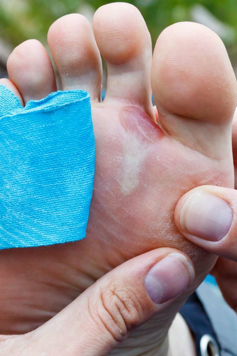 Should you pop a blister? When to do it, safe methods, and