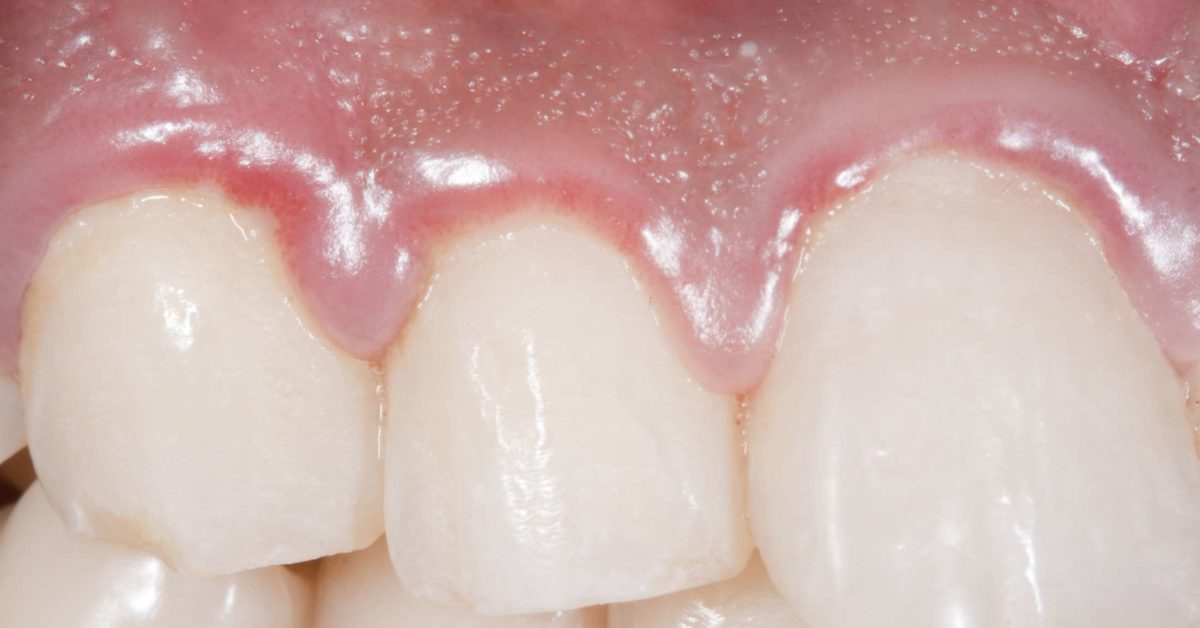 6-solutions-to-get-rid-of-swollen-gums-healthtopia