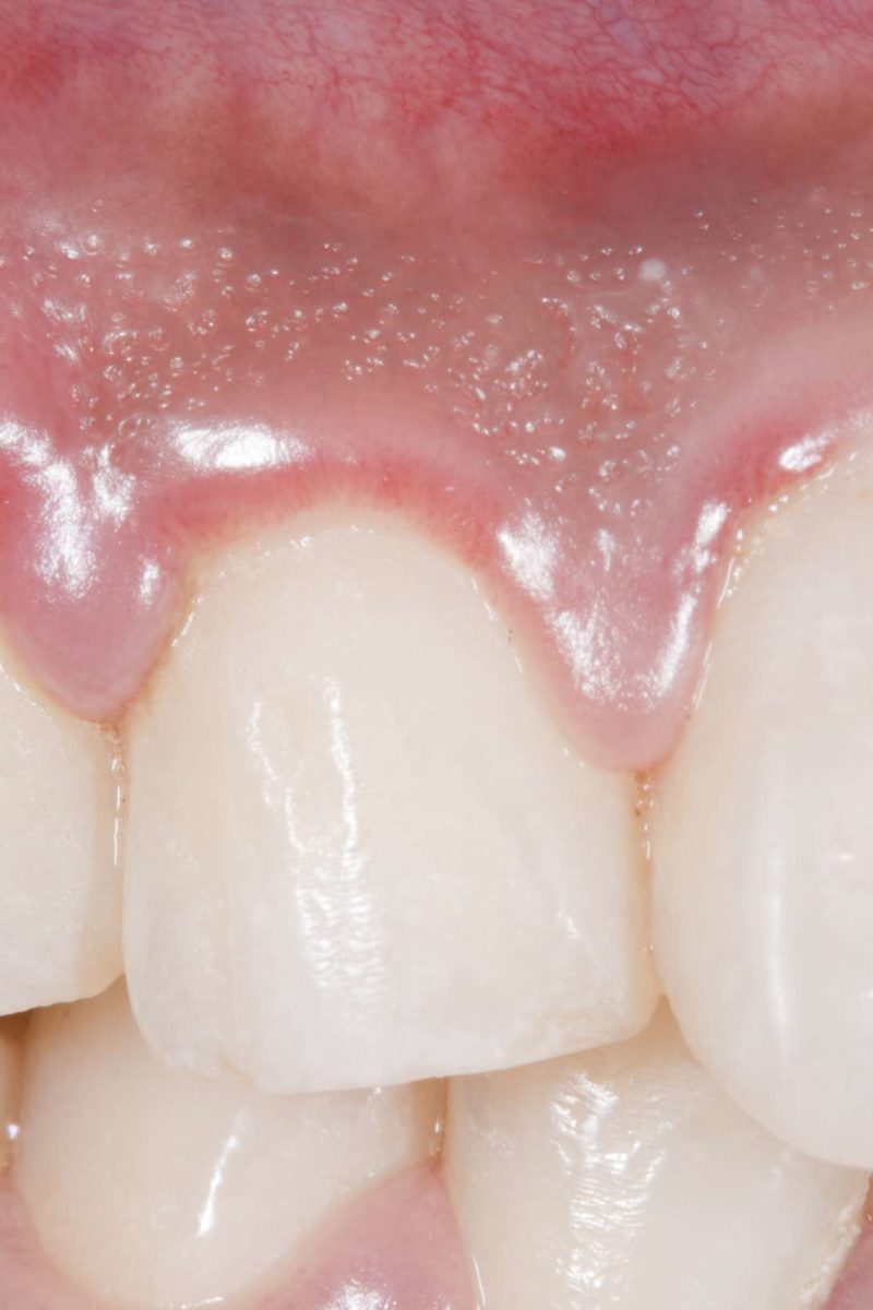 swollen-gums-causes-treatments-and-home-remedies