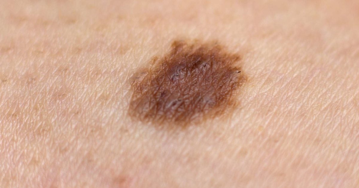 Is It Normal For A New Mole To Appear Causes And Warning Signs