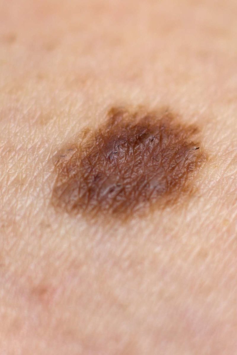 can-i-get-skin-cancer-from-moles-with-pictures