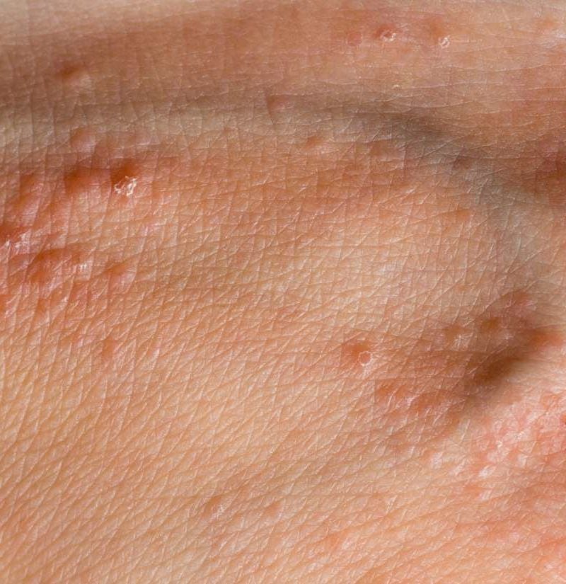 Tiny Red Bumps On Hands And Fingers