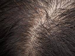 Cushing's syndrome: Could analyzing hair confirm diagnosis?