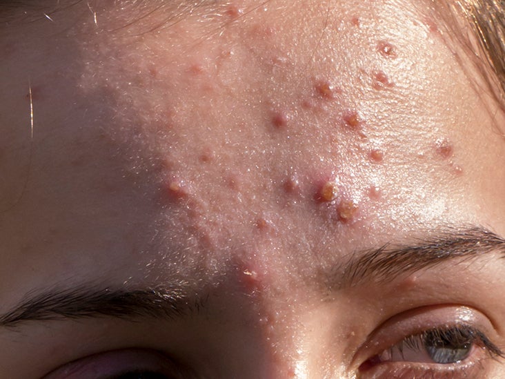 Inflamed acne: Treatments and prevention
