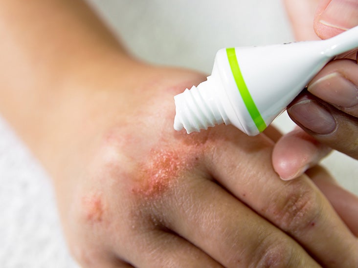 Rash on hands Causes and when to see a doctor Medical