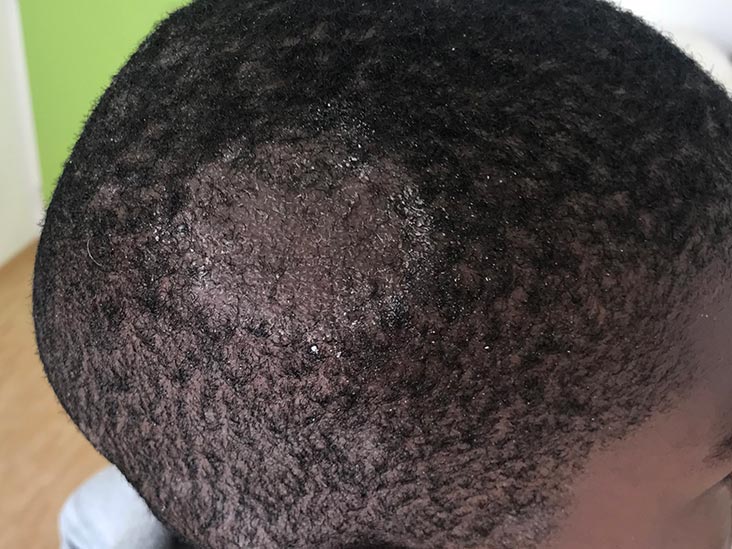 Ringworm rash: Pictures, treatments, and prevention - Medical News Today