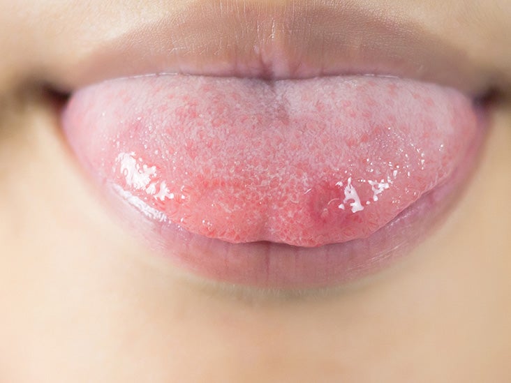 How To Canker Sore On Tongue