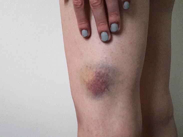 On legs bruises sex Unexplained Bruises: