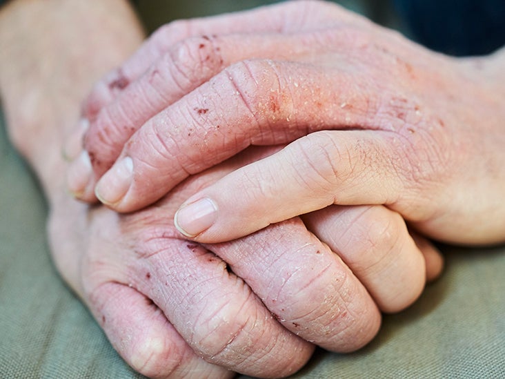 Hand eczema Treatment, prevention, and more Medical News Today